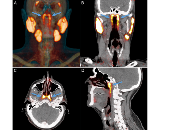 CT Scan Showing Salivary Gland Tissue