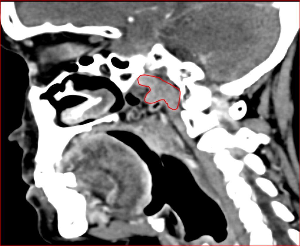 CT Visualization with Gland Outlines